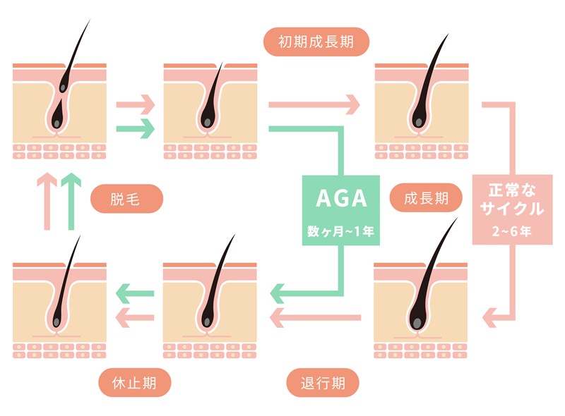 髪の成長サイクル（初期成長期、成長期、退行期、休止期、脱毛）と、AGA（アンドロゲン性脱毛症）が成長期を短縮し、通常2〜6年のサイクルを数ヶ月〜1年に変える影響を示す図。